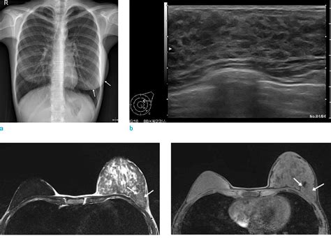 Breast Hypertrophy (Gigantomastia): Causes,。